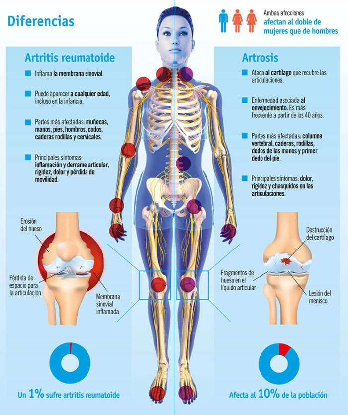 diferencias entre artritis y artrosis